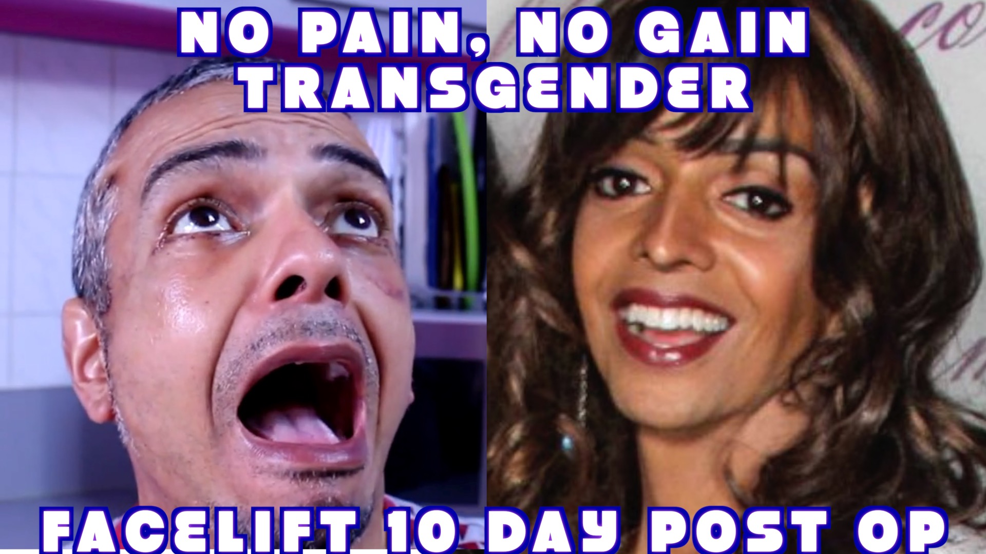 Read more about the article Transgender Facelift FFS 10 Day Post Op Dr. Jacono