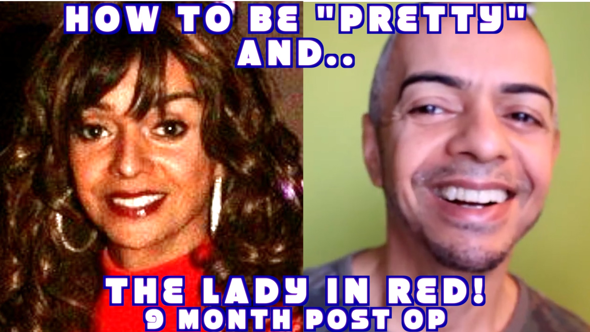 Read more about the article 9 month Post Op Dr. Andrew Jacono Facelift Lower Blepharoplasty Transgender