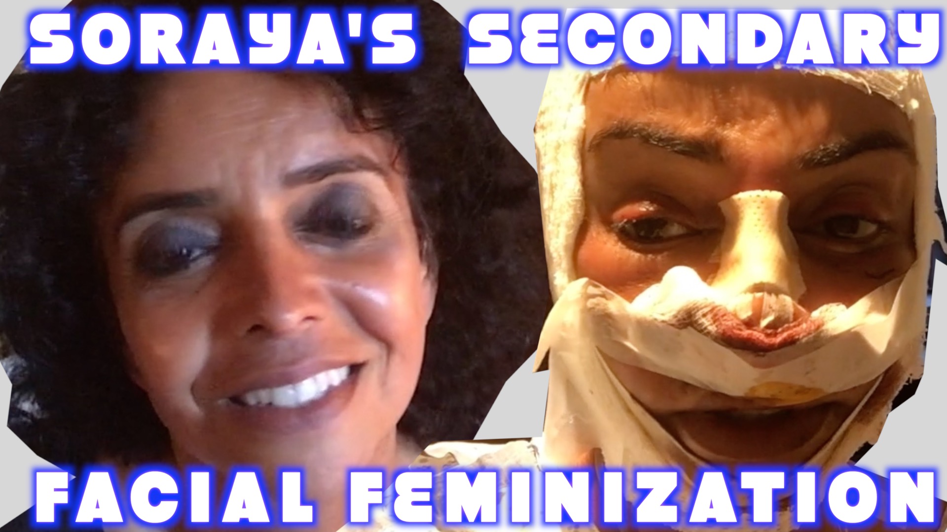Read more about the article Soraya’s Secondary Facial Feminization Surgery Transgender